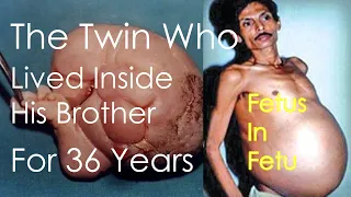 The Twin Who Lived Inside His Brother for 36 Years | Miracle In Medical Science | Fetus in Fetu