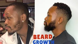 HOW I GREW MY BEARD USING MINOXIDIL / GET RID OF PATCHY BEARD