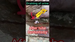 Tube Cystostomy l Retention of urine l dr umar khan
