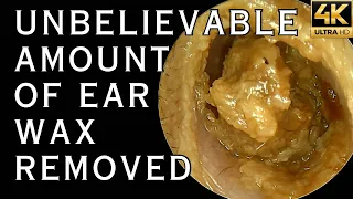 13 Minutes Non Stop SATISFYING Earwax Removal Video! (4K 60FPS)