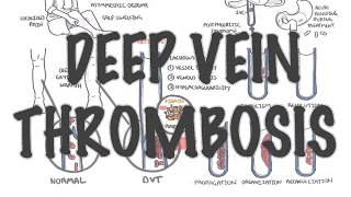 Deep Vein Thrombosis - Overview (pathophysiology, treatment, complications)