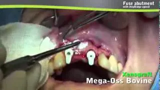 Implant AnyRidge : Immediate placement with Mega ISQ + Fuse Abutment