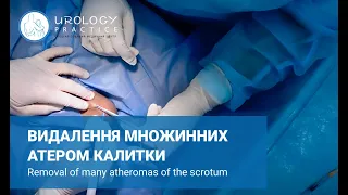 Видалення множинних атером калитки / Removal of multiple scrotum atheromatous / Аторемы мошонки