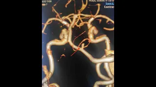Microsurgical Clipping of Vertebral artery -- PICA aneurysm