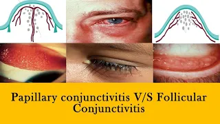 CONJUNCTIVITIS | papillae v/s follicles and membranes