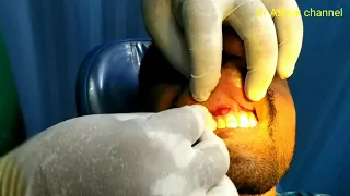 #Dental infection,#incision and drainage of dentoalveolar abscess