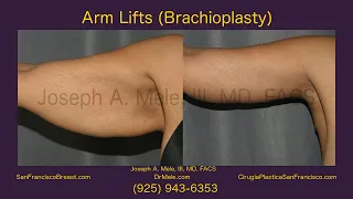 Arm Lift (Brachioplasty) in the SF Bay Area