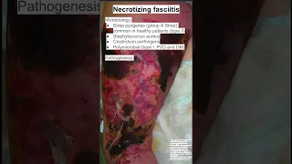Necrotizing fasciitis