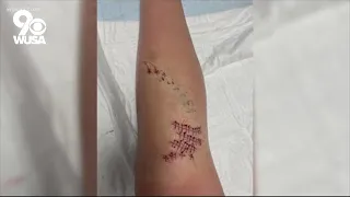12-year-old girl gets 42 stitches after suspected shark attack in Ocean City