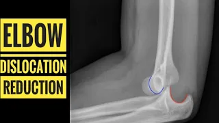 Elbow Dislocation Reduction Technique