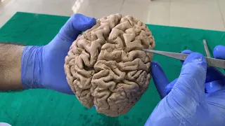 Dissection - Sulci & Gyri of Superolateral surface of brain