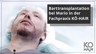 Barttransplantation bei Mario in der Fachpraxis KÖ-HAIR in Düsseldorf