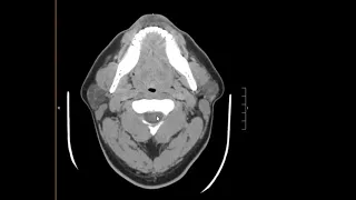 Normal CT neck