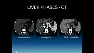 Characterization of Liver Masses with Contrast Enhanced US  What Sonographers Need to Know Ultrasoun