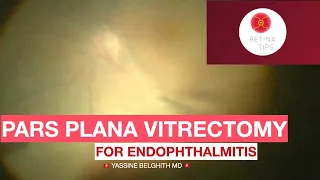 Pars plana vitrectomy in endophthalmitis