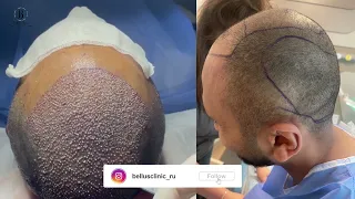 hair transplant in Bellus clinic in turkey