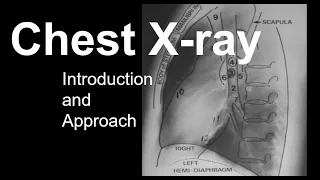 Chest X-ray: Introduction and Approach