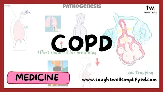 COPD Explained: Understanding the Causes, Symptoms, and Treatment