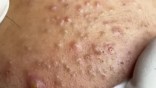 Blackheads & Whiteheads Satisfying Removal @0044