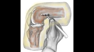 Femoral Skeletal Traction Pin Placement