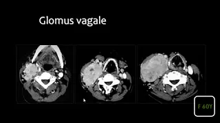 Dr Mamdouh Mahfouz head and neck imaging Infra hyoid neck II