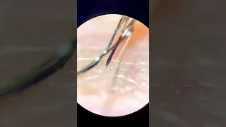 Mosquito bites my hand live under the microscope!