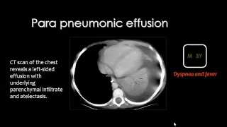 Imaging of Pediatirc chest III   Prof  Dr  Mamdouh Mahfouz In Arabic