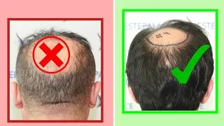 3 SIGNS You are a Good Hair Transplant Candidate!