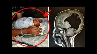 Kind kam ohne Gehirn zur Welt... 3 Jahre später entdecken Ärzte bei einer Untersuchung Folgendes...