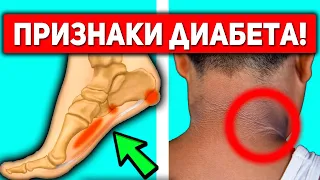 Как Распознать Первые Симптомы Диабета? Не Игнорируйте ЭТИ 15 Признаков Сахарного Диабета...