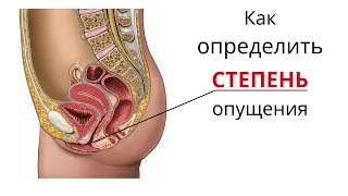 Как определить степень опущения матки и влагалища / Как опущение матки влияет на секс