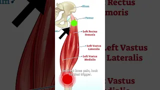 Rectus Femoris Trigger Points