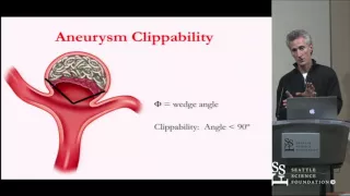 Surgical Management of Residual/Recurrent Aneurysms after Coiling by Michael Lawton, M.D.