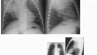 pediatric tuberculosis