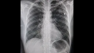 Pulmonary tuberculosis part 2