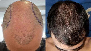 Результат пересадки волос 6,5 месяцев, 5100 графтов