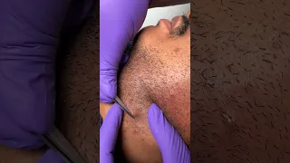 Satisfying ingrown hair removal on clients beard | beauty with bodden | #omg #ingrownhairremoval