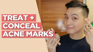 Treat + Conceal ACNE MARKS with this SKINCARE ROUTINE! (Filipino) | Jan Angelo