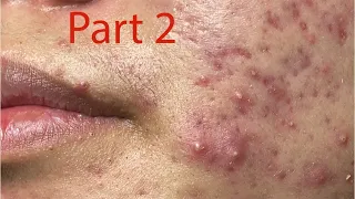 Make your Acne Treatment Huong Da Nang#448 part 2 | acne 2022
