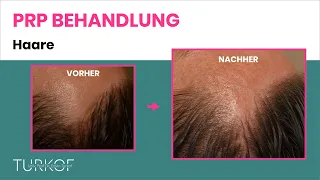 PRP Haare - Eigenbluttherapie bei Haarausfall | Dr. Turkof | 1060 Wien