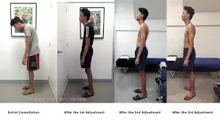Gonstead Chiropractic helps 19-year old patient with extreme kyphosis