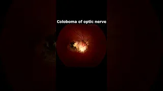 What diseases cause optic nerve damage