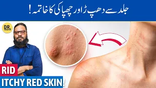 Kharish/Dhapper Ka Ilaj | Treat Urticaria/Hives on Skin | Dr. Ibrahim