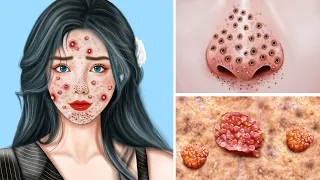 ASMR Warts & Black Head Pimple Removal - Acne Deep Cleaning Animation