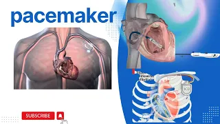 An Introduction to Pacemakers | Pacemakers  Powering Hearts | How pacemakers work |