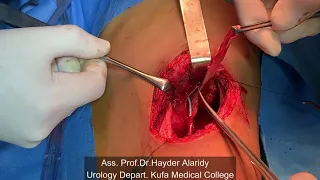 عملية تجميل حوض الكلية وفتح انسداد الحالب لطفل pyeloplasty.د.حيدر مهدي العارضي