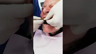 overdenture su locator