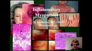 14 Inflammatory Myopathy: Dermatomyositis, Polymyositis, Inclusion Body Myositis, and others