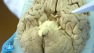 Нижняя поверхность головного мозга