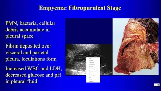 21 Pleural Disease